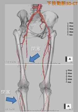 図4. 下肢動脈3D-CTにて右浅大腿動脈(SFA)に閉塞病変(矢印)を認める。