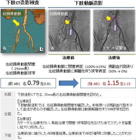図5. 風船・ステント治療の様子