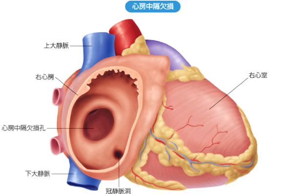 心房中隔欠損症:心房中隔に欠損孔が認められる。
