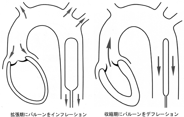 図:IABPの効果 拡張期(左)と収縮期(右)