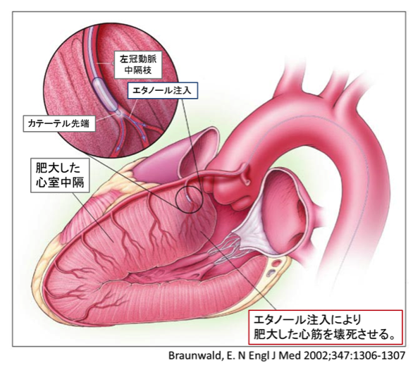 図2:経皮的経中隔心筋焼却術(PTSMA) の様子