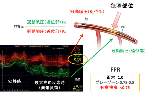 図:冠血流予備量比 (FFR) の説明