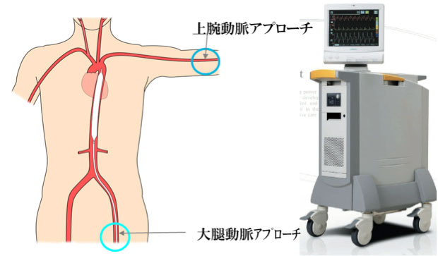 図:IABPバルーンカテーテルの挿入部位・留置場所(左)と外部駆動装置(右)