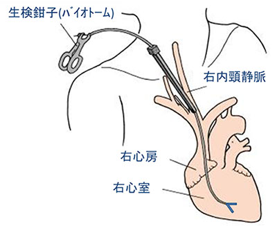 図:心内膜心筋生検の様子(右室心内膜生検の場合)