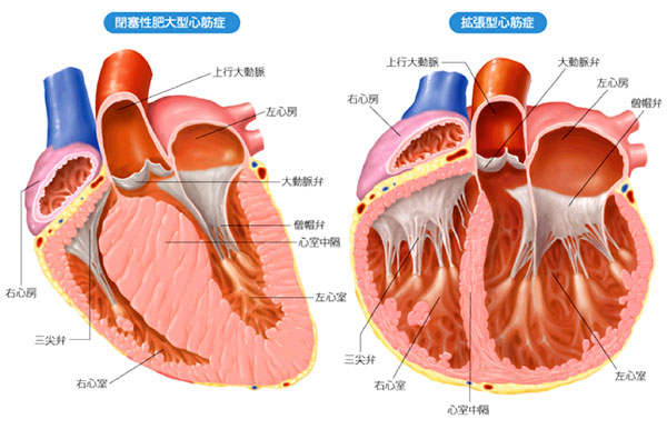 図: 心筋症の例(左;肥大型心筋症 右;拡張型心筋症)