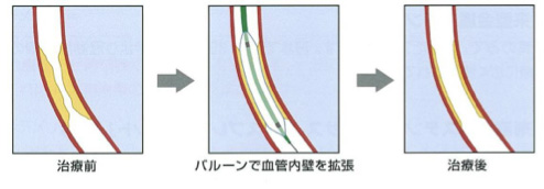 図2:風船治療