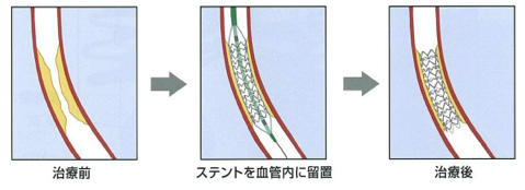 図3:ステント留置術