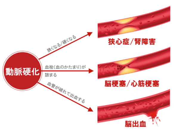 生活習慣病と心臓血管病 阪和記念病院