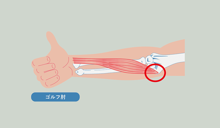 内側の肘の上部で痛みや炎症が発生する状態です。主に手首を屈曲する動作や掴む動作（投球、重い物をつかむなど）によって引き起こされることが多いです。