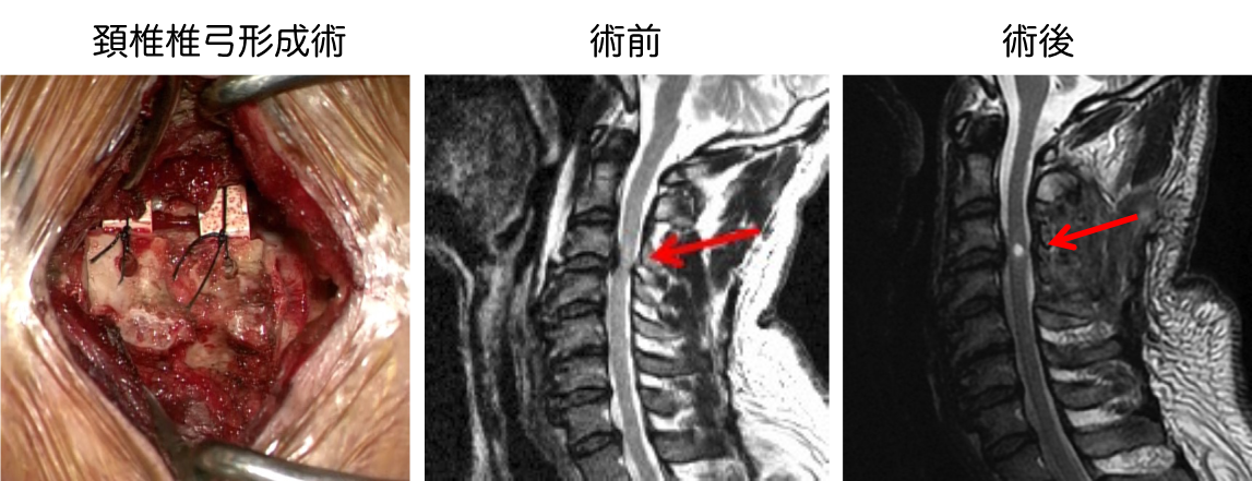 頚椎症・頚部脊柱管狭窄症・頚椎椎間板ヘルニアに対する手術