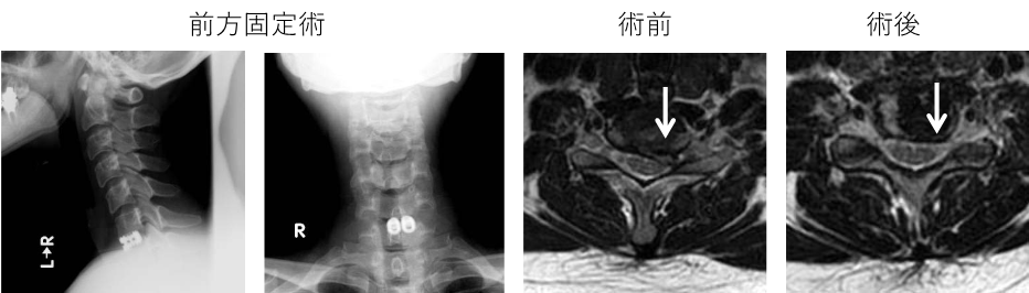頚椎症・頚部脊柱管狭窄症・頚椎椎間板ヘルニアに対する手術