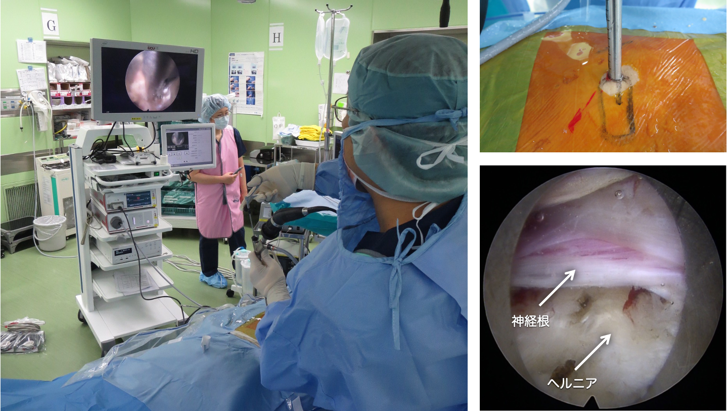 Full-endoscopic spine surgery（FESS)