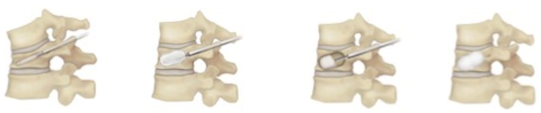 骨粗鬆症性椎体骨折（圧迫骨折）に対するバルーン椎体形成術
