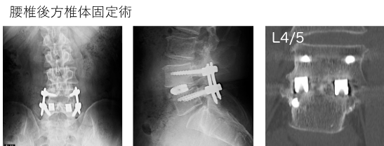 骨粗鬆症性椎体骨折（圧迫骨折）に対するバルーン椎体形成術
