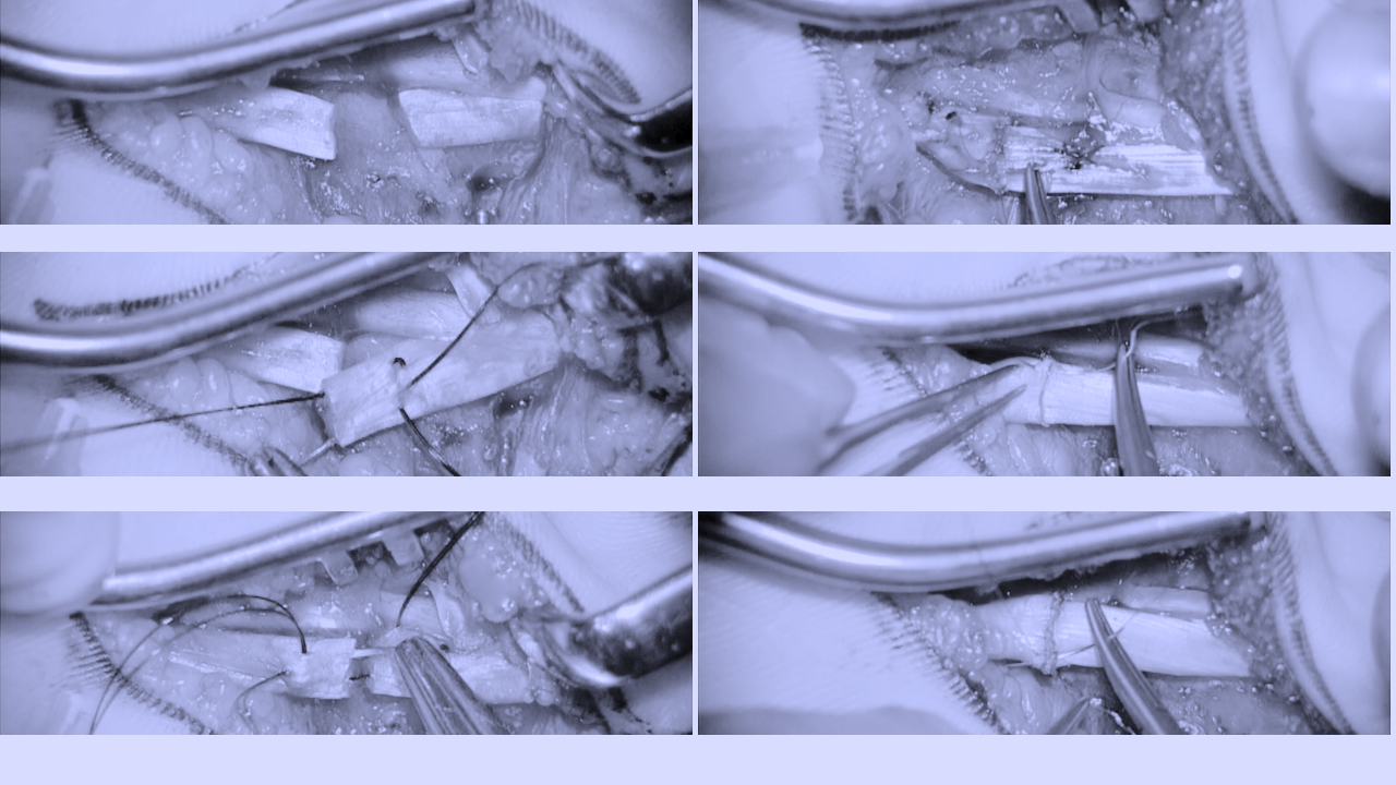 No-mans-landでの屈筋腱縫合白黒