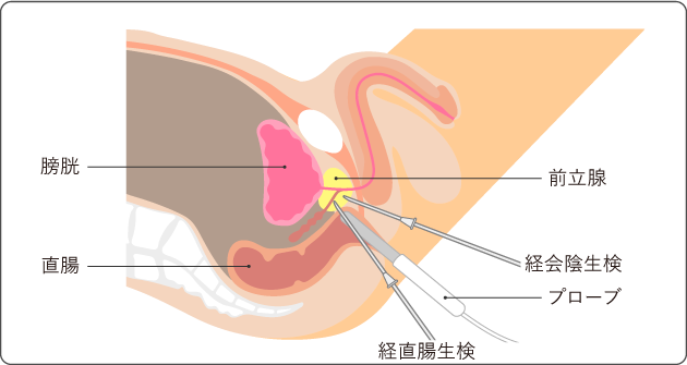 前立腺がん検査
