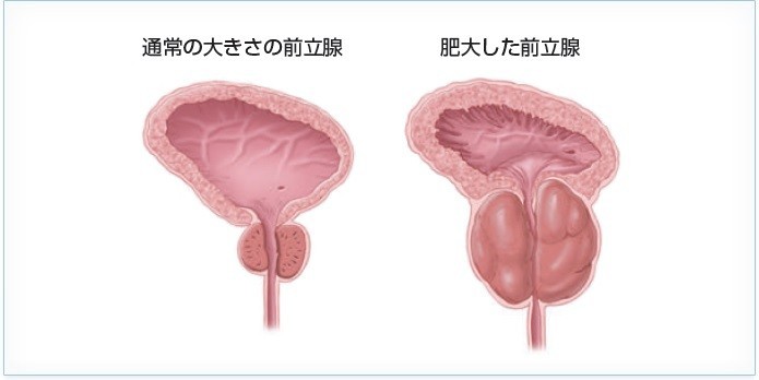 前立腺肥大