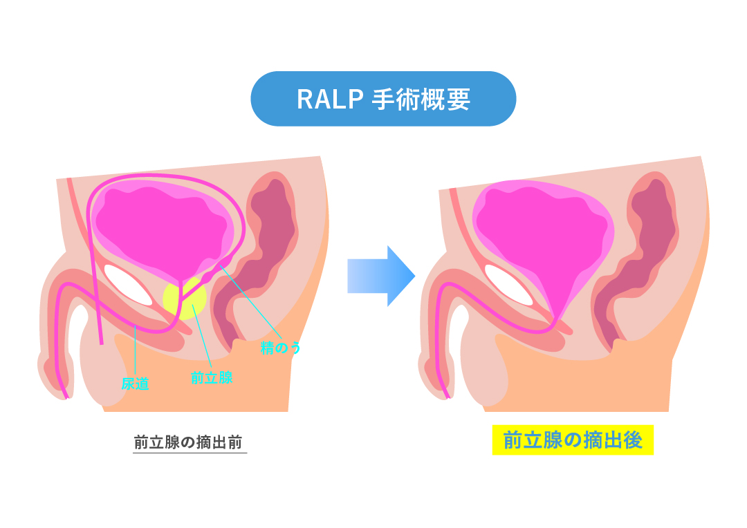 RALP